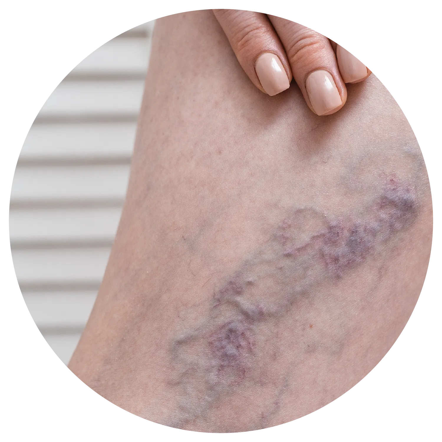 Spider Veins treatment process at Toronto medical spa - Understand what your skin is trying to tell you.